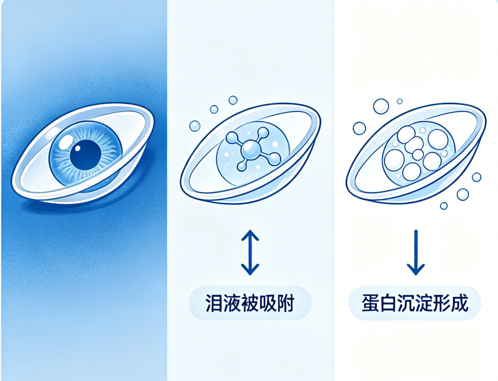 长期戴隐形眼镜,为何容易得干眼症?原因和护眼准则一次性讲清