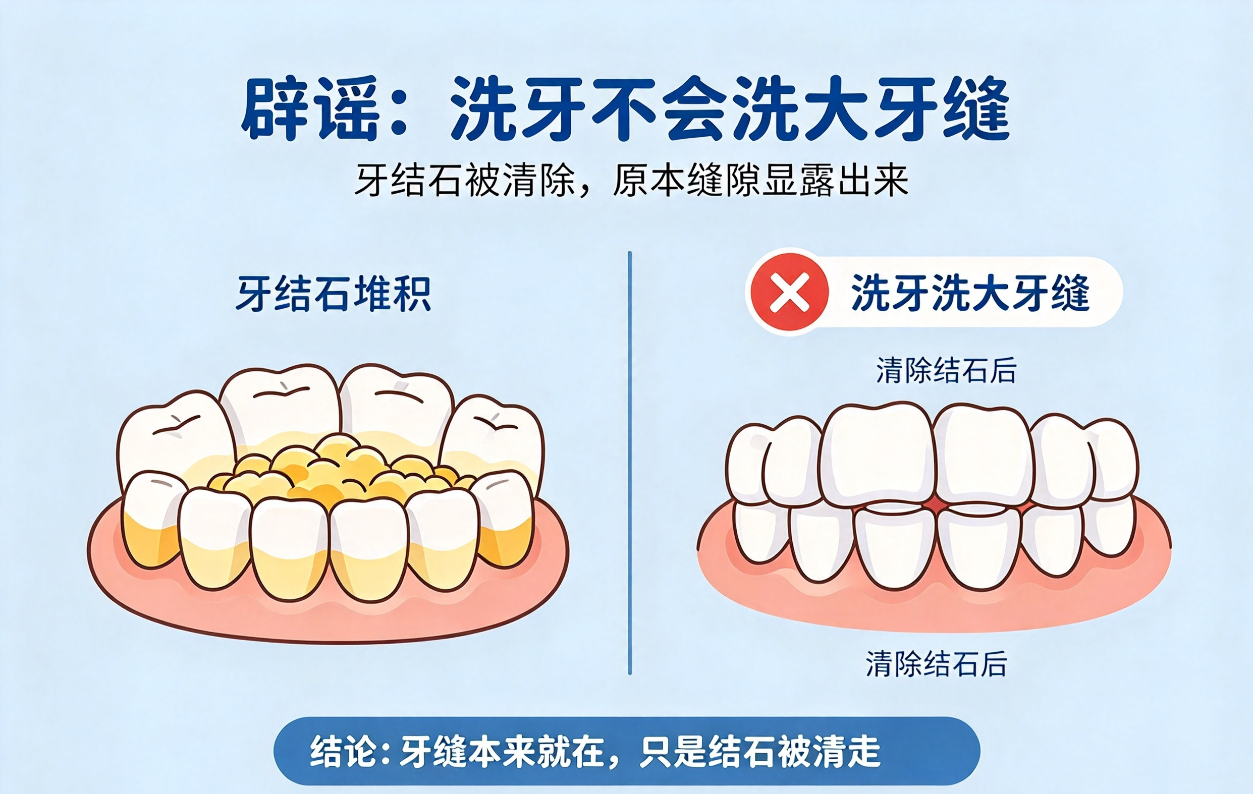 洗牙把牙缝洗大?其实是误会一场